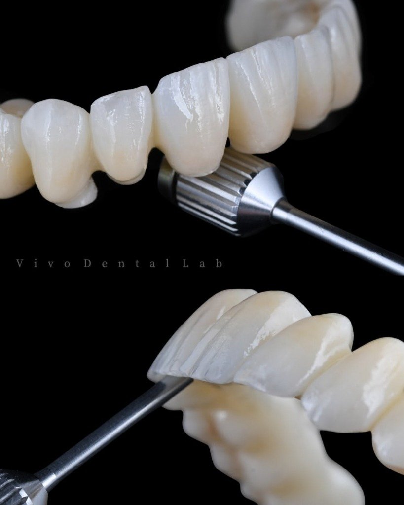 Biomimetic Composite Restorations