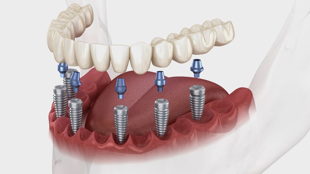 Basal Implants