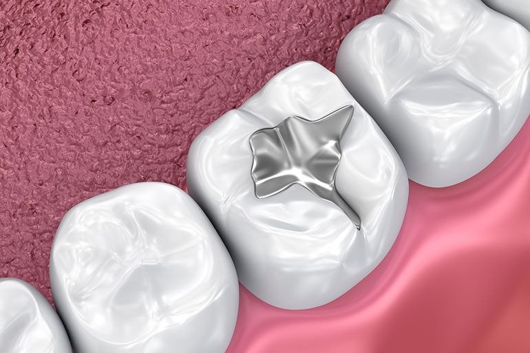 Dental Fillings