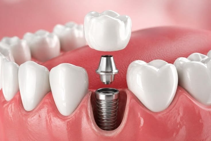 Dental Implants
